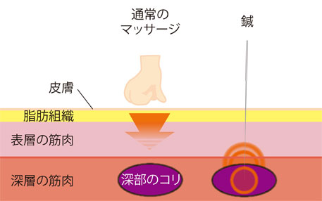 指圧と鍼の図