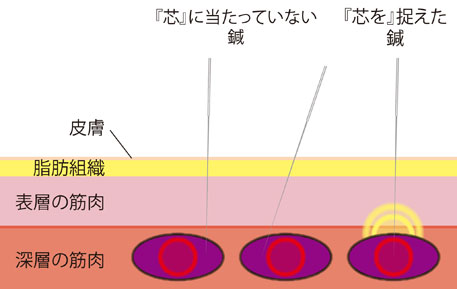 鍼と鍼の図