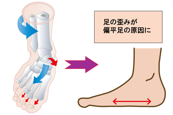 偏平足