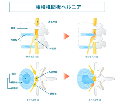 椎間板ヘルニアの図