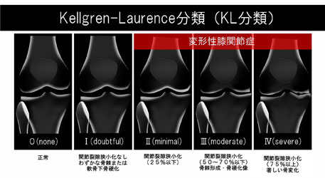 変形の重症度と痛みは関係がある