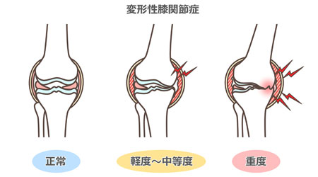 変形性膝関節症