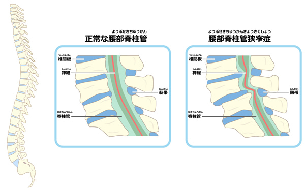 脊柱管狭窄症とは？