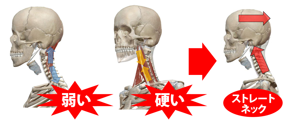 ストレートネックの説明