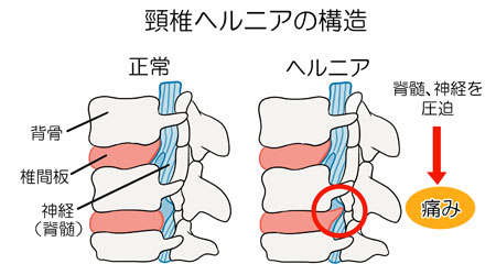 頚椎ヘルニアの構造