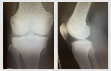 変形性膝関節症は『膝が悪い』ことで引き起こされる