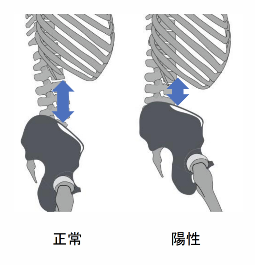 骨盤と下部肋骨との距離を確認する評価