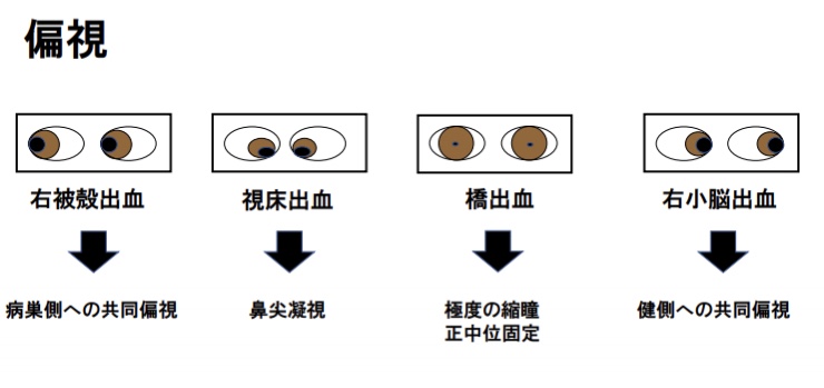 脳内出血の出血部位と偏視の方向を示した図