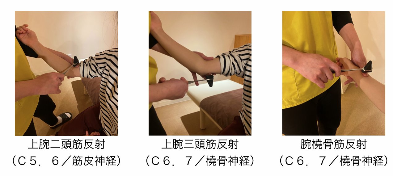 深部腱反射の亢進や減弱を総合的に判断する説明図