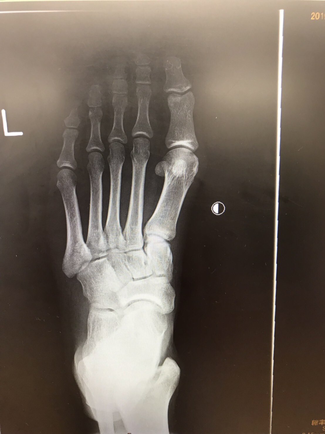 下駄骨折が確認された足部レントゲン画像
