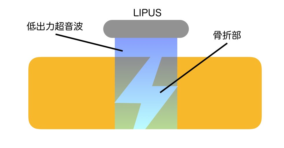 LIPUSによる骨折部への低出力パルス超音波