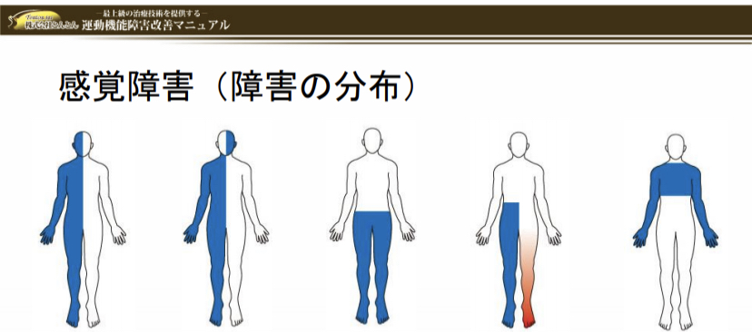 感覚障害の分布として見る図