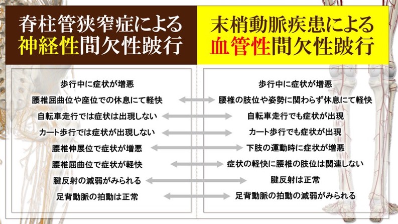 神経性間欠性跛行と血管性間欠性跛行の違い
