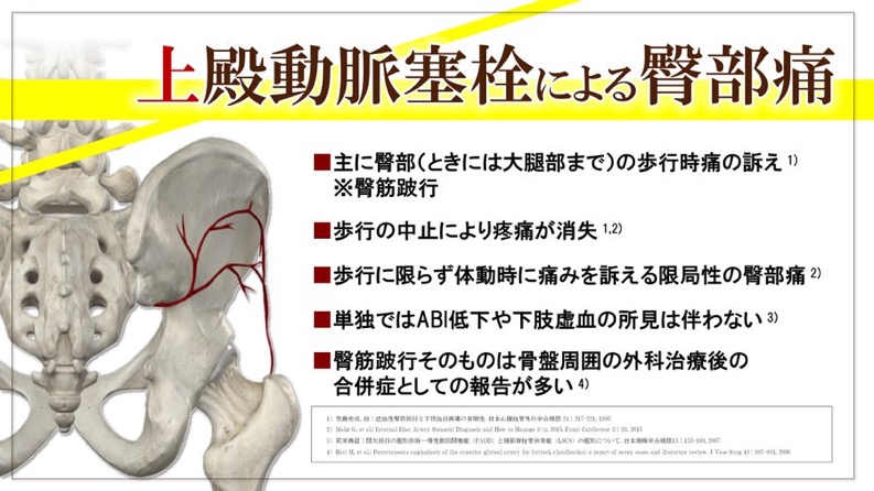歩行時の臀部痛と上殿動脈閉塞についての説明画像