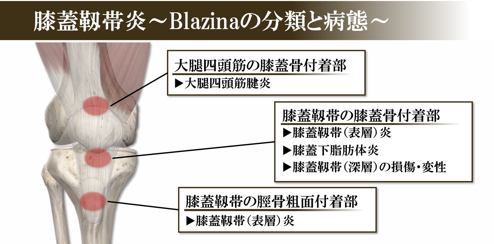 膝蓋靭帯炎におけるブラジナ分類と病態のまとめ
