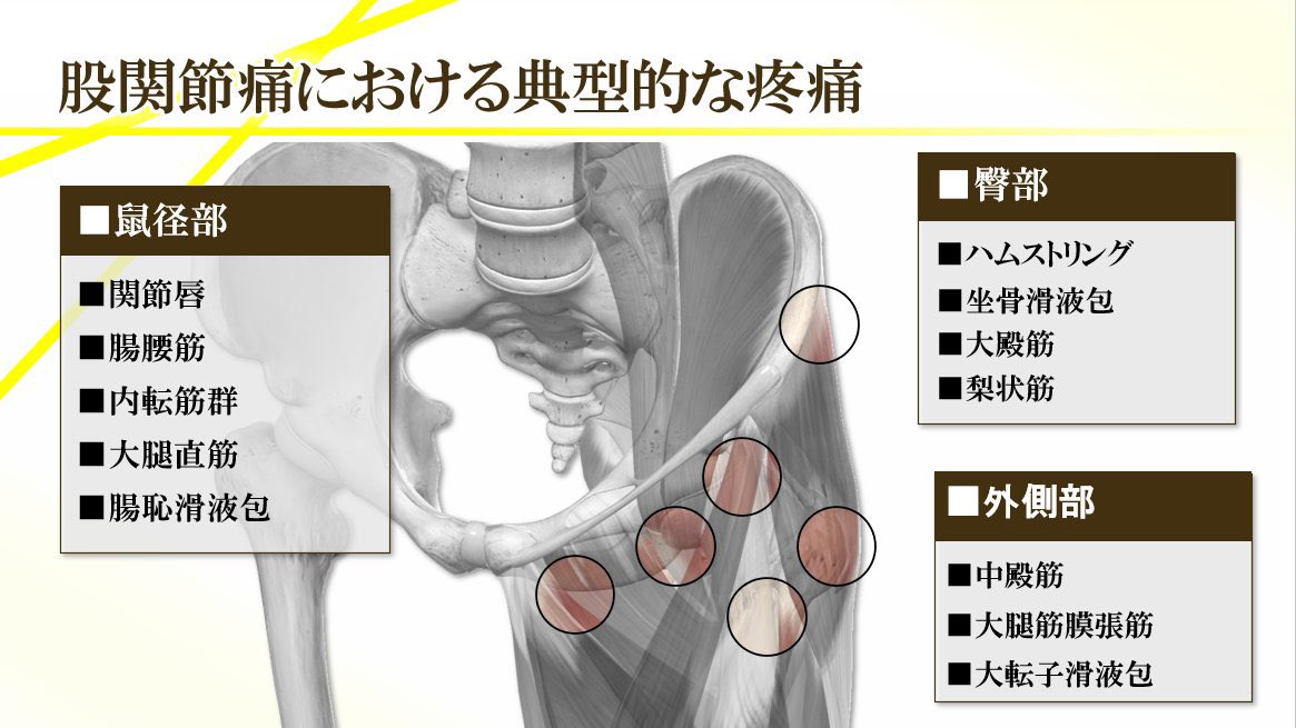 股関節痛における典型的な疼痛部位