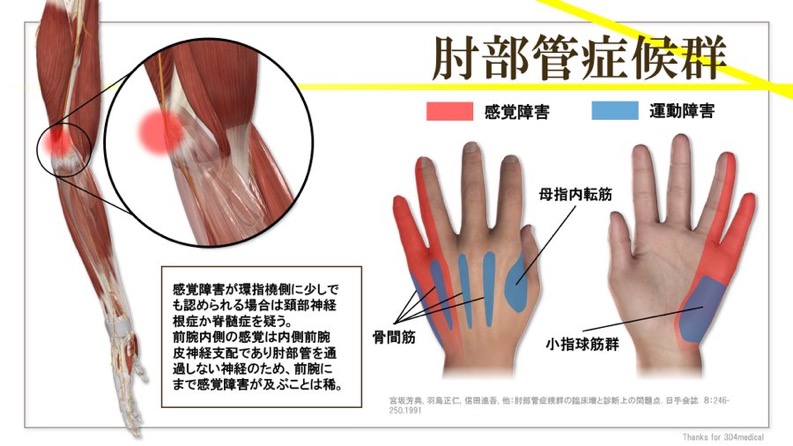 肘部管症候群の評価で確認したい検査所見