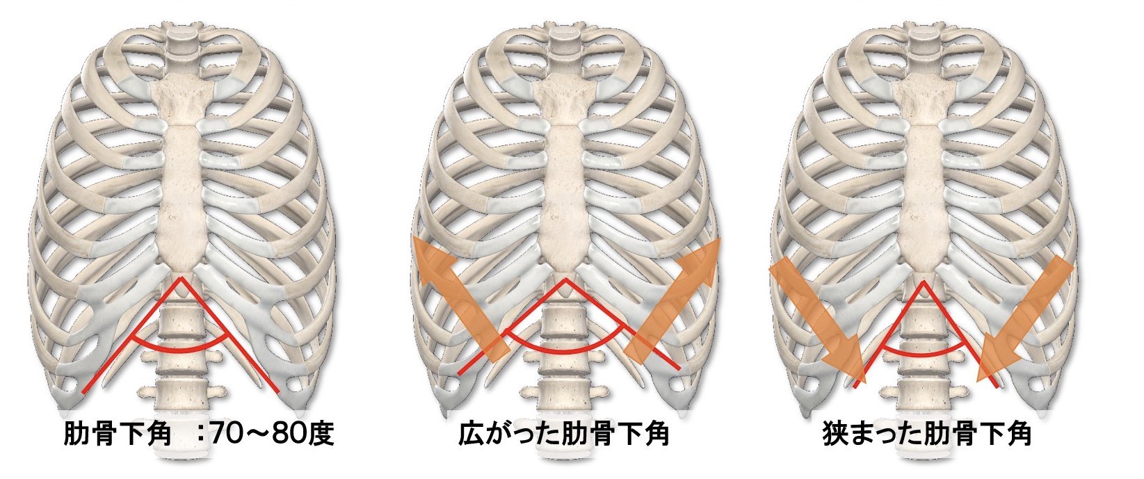 肋骨下角の正常・広がり・狭まりを比較した図