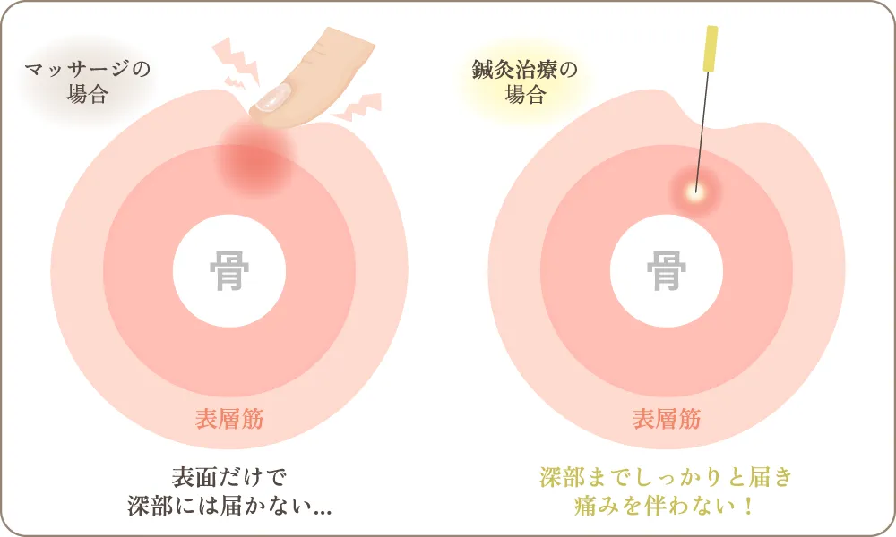 手の施術は表層にとどまりやすく、鍼（はり）は深いところの芯に届きやすいと言われて
