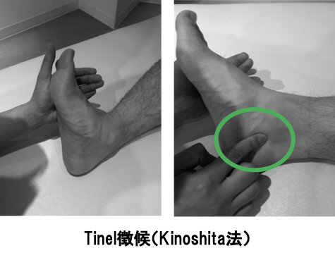 足根管症候群のチネル徴候