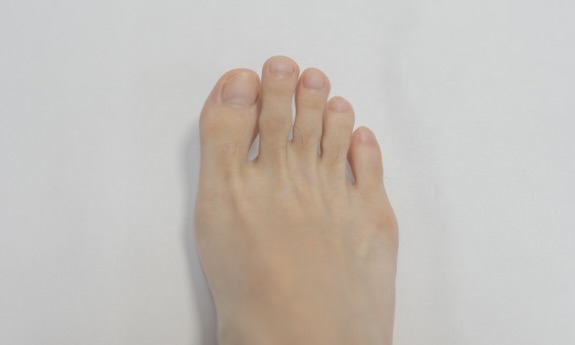 小指が薬指側に傾いた足の甲