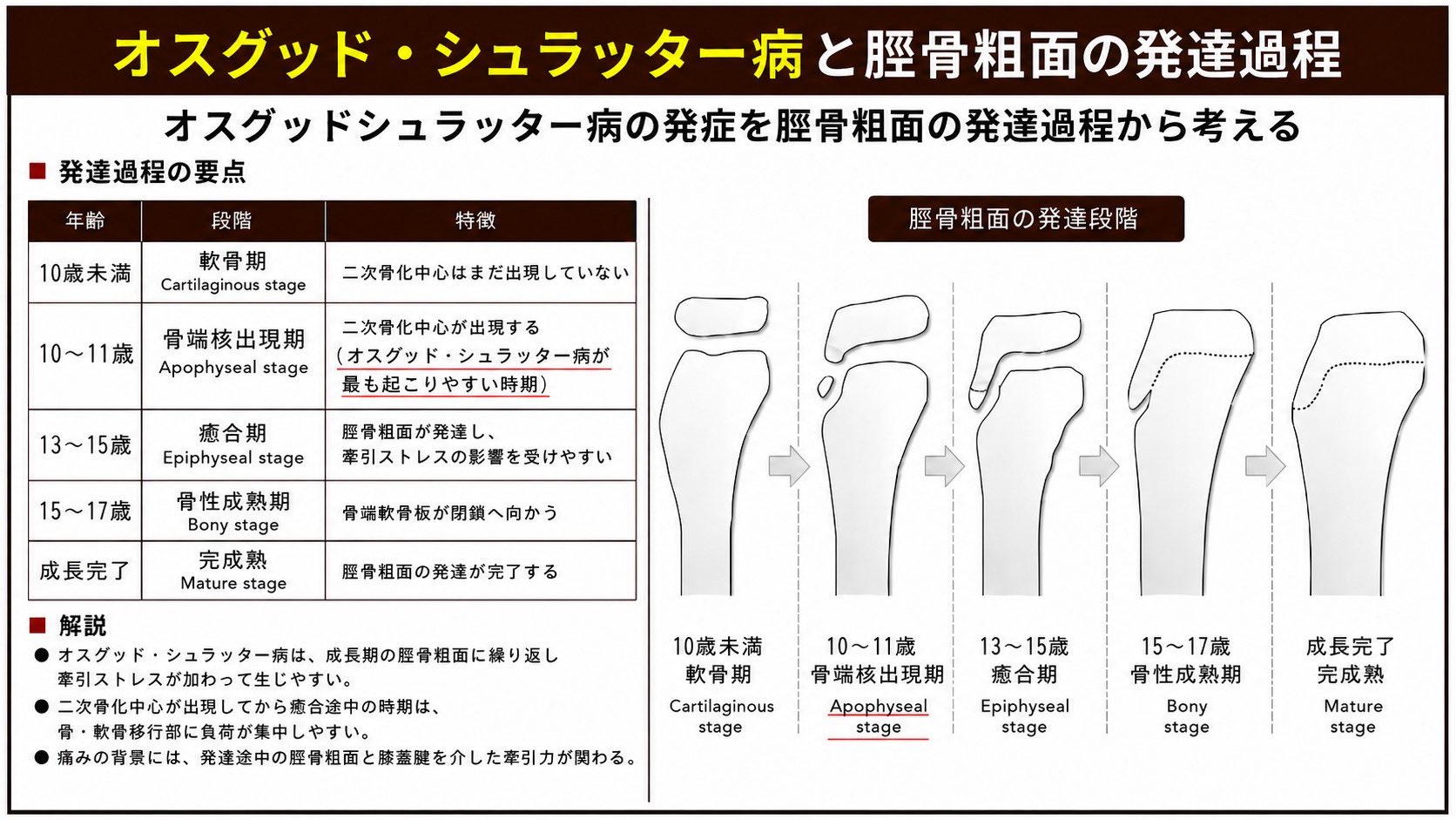 オスグッド・シュラッター病と脛骨粗面の発達過程。年齢と発達段階、脛骨粗面の形の変化を示した図表