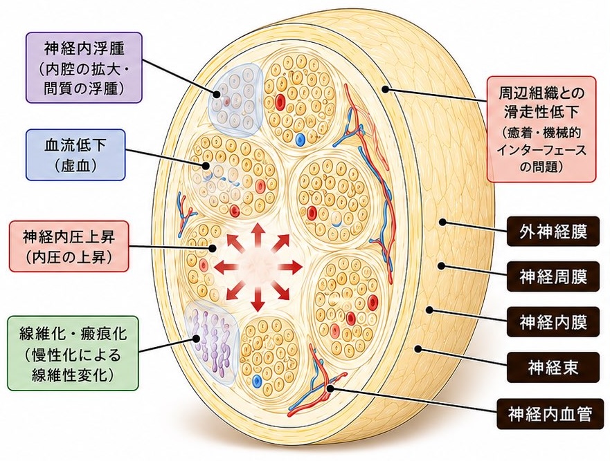 末梢神経の断面図。外神経膜・神経周膜・神経内膜・神経束・神経内血管の層構造と、神経内浮腫・血流低下・神経内圧上昇・線維化・周辺組織との滑走性低下が起きる場所