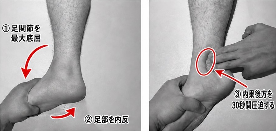 足関節を最大底屈し、足部を内反させ、内果後方を30秒間圧迫する手順の写真