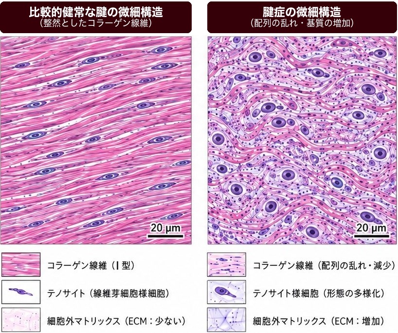 健常な腱と腱症の腱の微細構造の比較。左の比較的健常な腱は整然と並んだコラーゲン線維（Ⅰ型）で細胞外マトリックスが少なく、右の腱症の腱はコラーゲン線維の配列が乱れ、テノサイト様細胞の形態が多様化し、細胞外マトリックスが増えている