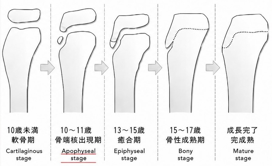 脛骨粗面の発達段階。軟骨期・骨端核出現期・癒合期・骨性成熟期・完成熟の5段階の骨の形を並べた図