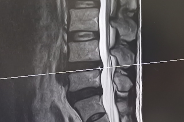 腰椎のMRI（エムアールアイ）画像のイメージ